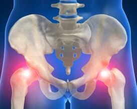 causes of arthrosis of the hip joint